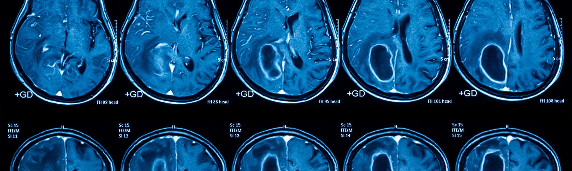 Magnetic resonance imaging (MRI) of the brain, brain tumor