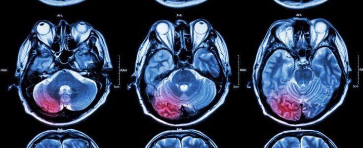 Brain tumor x ray