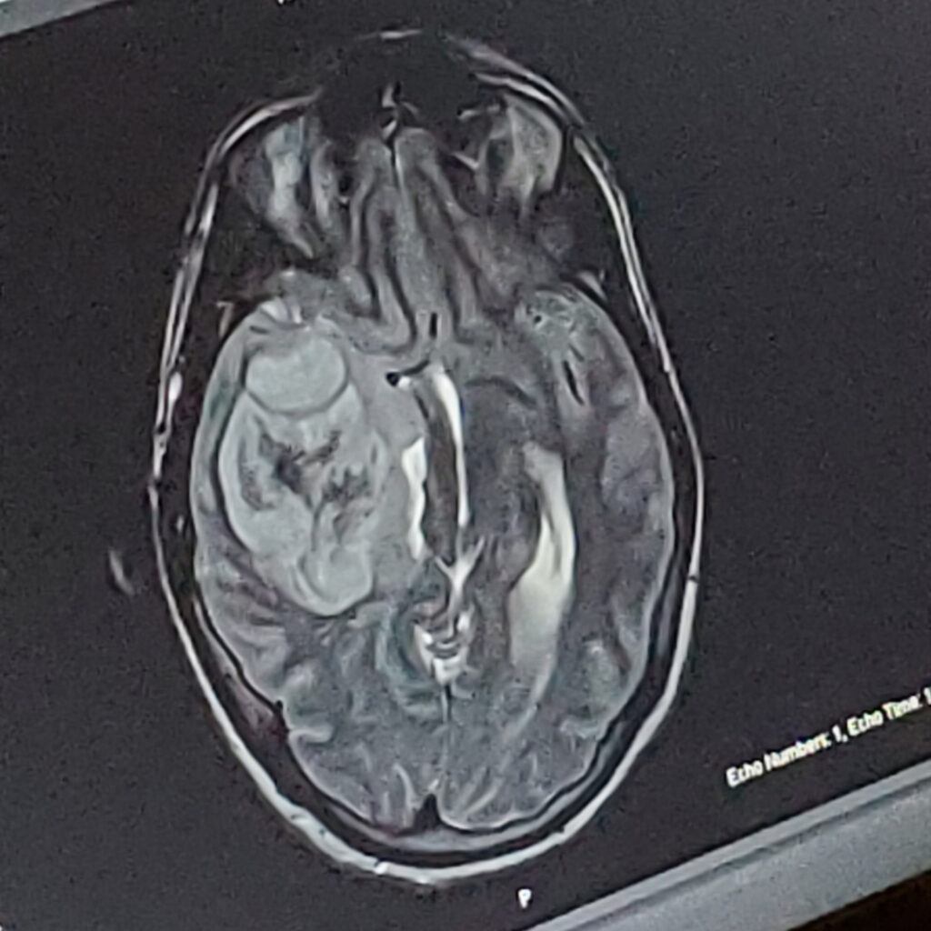 Resonancia magnética de un tumor