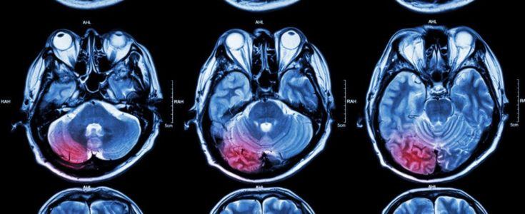 Brain scans noting where a brain tumor lies