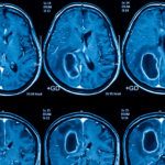 Magnetic resonance imaging (MRI) of the brain, brain tumor