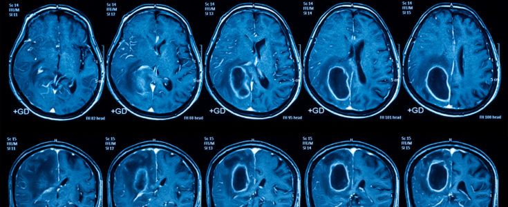 Magnetic resonance imaging (MRI) of the brain, brain tumor