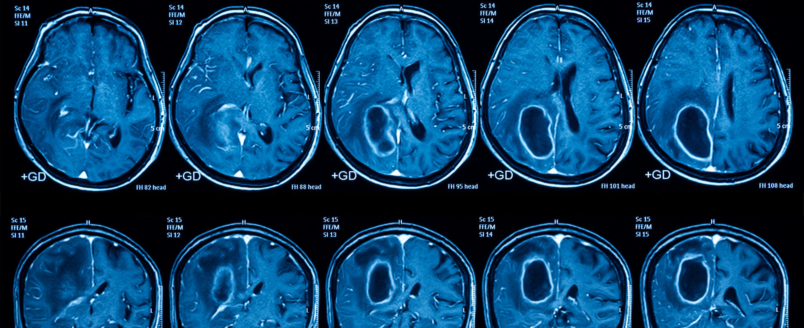clinical trials for brain tumors