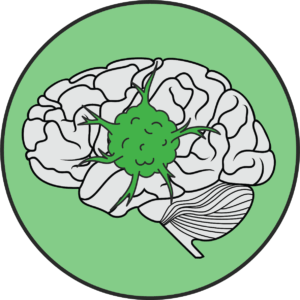 Glioblastoma Tumor Illustration