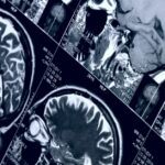 Brain imaging