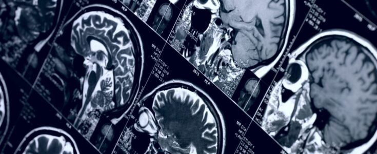 Brain imaging