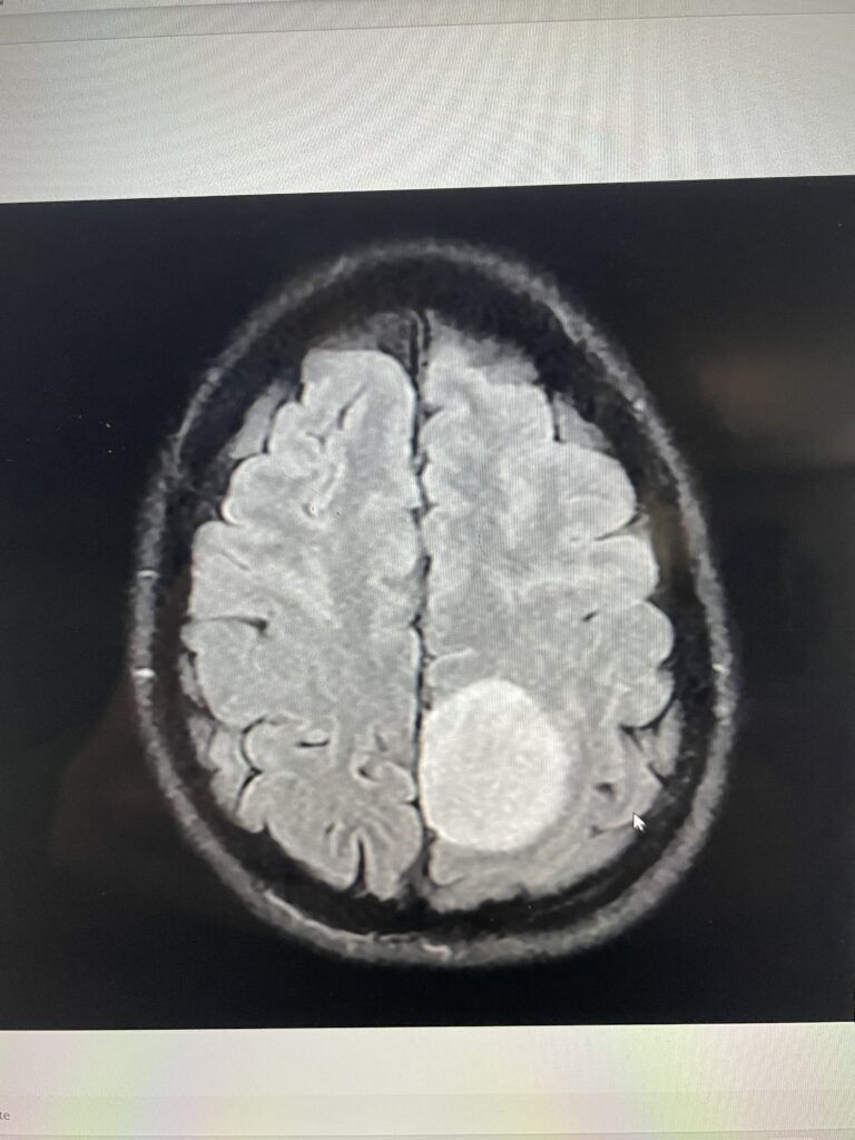 Marie's brain imaging